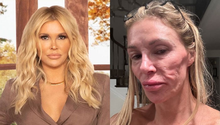 Brandi Glanville ‘desperately’ wants solution for facial disfigurement